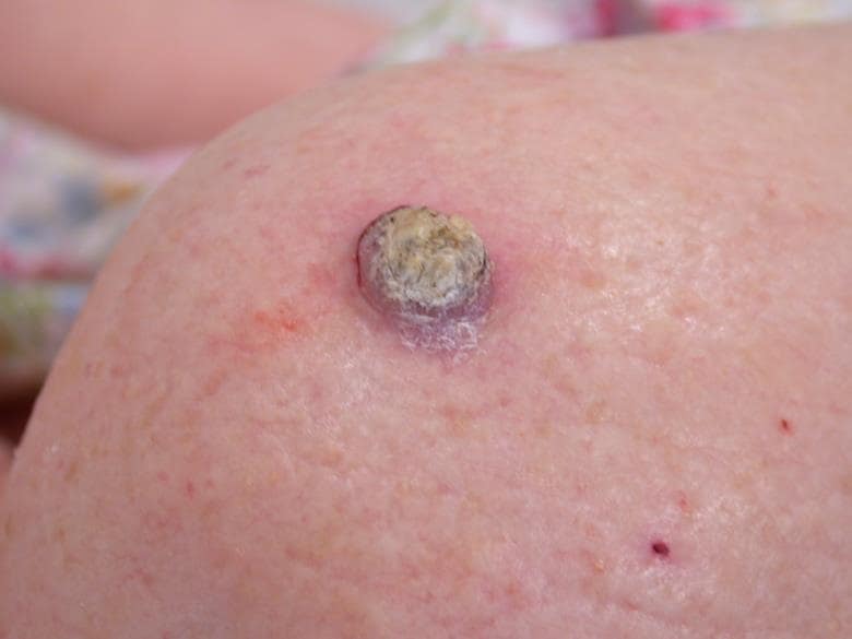 Figure 2: Squamous cell carcinoma